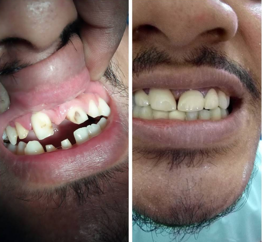 Before and after photo of chipped and discoloured front teeth restored at Jalpaiguri Dental Clinic