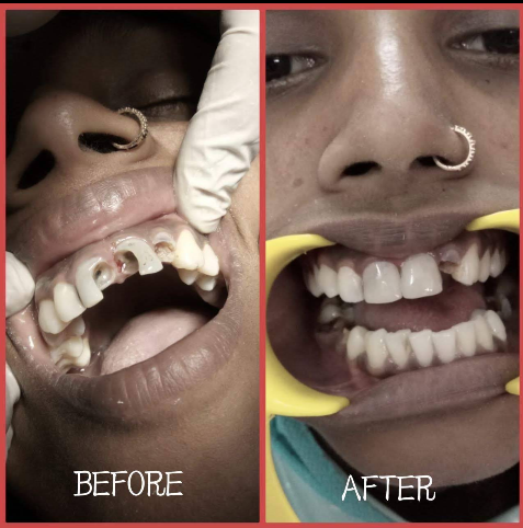 Before and after photo of a dental crown fitting at Jalpaiguri Dental Clinic